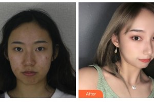 邯鄲愛爾眼科醫(yī)院江春華整形價格表附切開雙眼皮案例展示