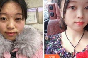 邯鄲愛(ài)爾眼科醫(yī)院呂偉整形價(jià)格表附眼部綜合案例展示