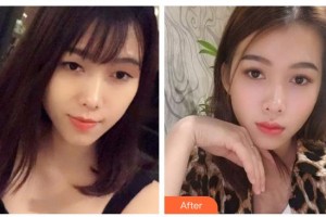 邯鄲凱潤婷整形美容醫(yī)院梁如光整形價格表附切開雙眼皮案例展示