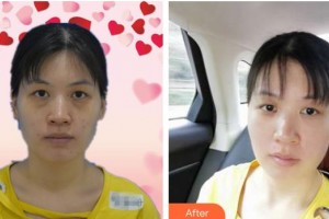 邯鄲貝潔口腔醫(yī)院李東娟整形價(jià)格表附眼部綜合案例展示