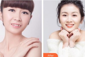 邯鄲佑熙醫(yī)療美容門(mén)診部孫堅(jiān)整形價(jià)格表附隱形托槽矯正案例展示