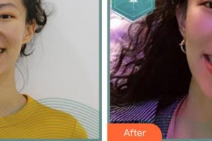 邯鄲貝潔口腔醫(yī)院史超整形價(jià)格表附隱形托槽矯正案例展示