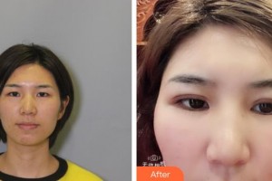 漢口愛爾眼科醫(yī)院陳茜整形價(jià)格表附切開雙眼皮案例展示