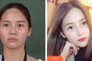 漢口愛爾眼科醫(yī)院譚維娜整形價(jià)格表附切開雙眼皮案例展示