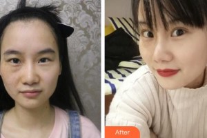 漢口愛爾眼科醫(yī)院吳立平整形價(jià)格表附眼部綜合案例展示