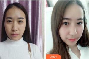 漢口愛爾眼科醫(yī)院謝小華整形價(jià)格表附切開雙眼皮案例展示