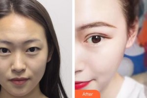 漢口愛爾眼科醫(yī)院鄭亦君整形價(jià)格表附切開雙眼皮案例展示