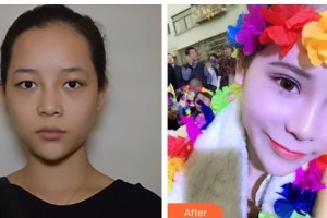 漢口愛爾眼科醫(yī)院周賢芝整形價(jià)格表附眼部綜合案例展示