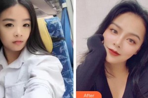 漢口愛爾眼科醫(yī)院王育紅整形價(jià)格表附眼部綜合案例展示