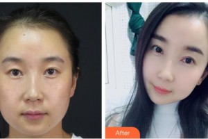 漢口愛爾眼科醫(yī)院王浩宇整形價(jià)格表附眼部綜合案例展示