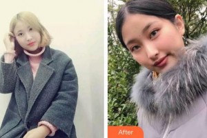 漢口愛爾眼科醫(yī)院鄭一晨整形價(jià)格表附眼部綜合案例展示