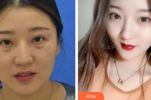 漢口愛爾眼科醫(yī)院江柯整形價(jià)格表附埋線雙眼皮案例展示