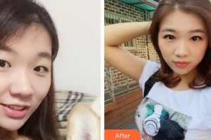 漢口愛爾眼科醫(yī)院程建宏整形價(jià)格表附定點(diǎn)雙眼皮案例展示