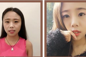 懷化市第一人民醫(yī)院尹榮林整形價格表附牙齒隱形矯正案例展示