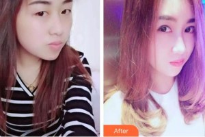 湘西麗人整形美容醫(yī)院徐娟整形價(jià)格表附切開雙眼皮案例展示