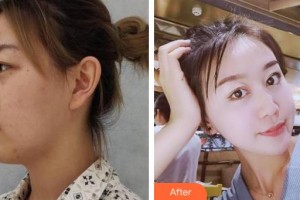 湘西愛爾眼科醫(yī)院譚米特整形價(jià)格表附眼部綜合案例展示