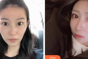 湘西愛爾眼科醫(yī)院田明整形價(jià)格表附眼部綜合案例展示