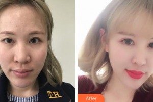 湘西愛爾眼科醫(yī)院馮菊芝整形價(jià)格表附切開雙眼皮案例展示