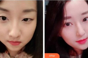 湘西愛爾眼科醫(yī)院田勇輝整形價(jià)格表附切開雙眼皮案例展示