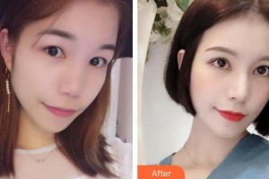 湘西愛爾眼科醫(yī)院黃慧整形價(jià)格表附切開雙眼皮案例展示