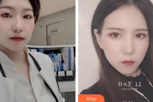 深圳德視佳眼科門診部姚文琴整形價(jià)格表附切開雙眼皮案例展示