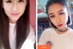 深圳市眼科醫(yī)院杜冰整形價(jià)格表附切開雙眼皮案例展示