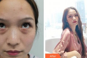 深圳德視佳眼科門診部賀純純整形價格表附激光去眼袋案例展示