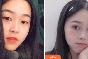 深圳市眼科醫(yī)院賀溫玲整形價格表附切開雙眼皮案例展示