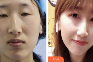 深圳市眼科醫(yī)院孫良南整形價格表附眼部綜合案例展示