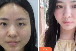 深圳市眼科醫(yī)院聶丹瑤整形價(jià)格表附激光去眼袋案例展示