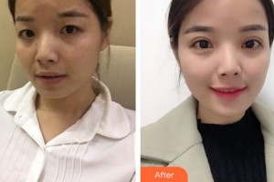 深圳市眼科醫(yī)院唐松整形價(jià)格表附切開(kāi)雙眼皮案例展示