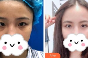 深圳華夏眼科醫(yī)院孫同整形價格表附切開雙眼皮案例展示