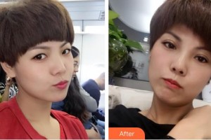 深圳市眼科醫(yī)院佘潔婷整形價格表附眼部修復(fù)案例展示