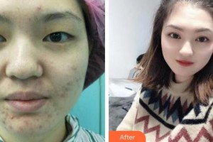 深圳?，斄猪槼毖劭漆t(yī)院林順潮整形價格表附眼部綜合案例展示