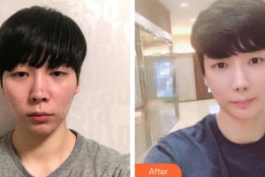 深圳愛爾眼科醫(yī)院林晨整形價格表附眼部修復(fù)案例展示