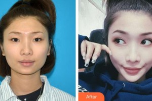 深圳愛爾眼科醫(yī)院李雙農(nóng)整形價格表附開內(nèi)眼角案例展示