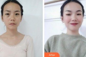 深圳市眼科醫(yī)院羅康怡整形價格表附激光去眼袋案例展示