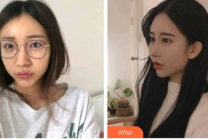 深圳愛爾眼科醫(yī)院夏娟整形價格表附內(nèi)切祛眼袋案例展示