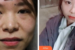 深圳愛爾眼科醫(yī)院司馬晶整形價格表附內(nèi)切祛眼袋案例展示