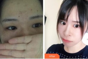 深圳愛爾眼科醫(yī)院鄧宏偉整形價格表附定點(diǎn)雙眼皮案例展示