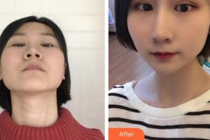 深圳愛爾眼科醫(yī)院陳炳衡整形價格表附眼部綜合案例展示