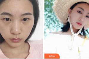 深圳愛爾眼科醫(yī)院金童實(shí)整形價格表附眼部綜合案例展示