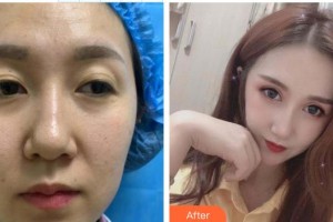 深圳愛爾眼科醫(yī)院李敏超整形價格表附眼部綜合案例展示