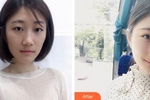 深圳愛爾眼科醫(yī)院楊化學(xué)整形價格表附定點(diǎn)雙眼皮案例展示