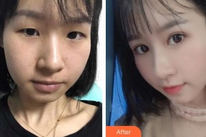 深圳愛爾眼科醫(yī)院凌受良整形價格表附切開雙眼皮案例展示