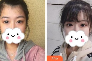 深圳愛爾眼科醫(yī)院謝金榮整形價格表附眼部綜合案例展示