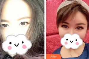 深圳愛爾眼科醫(yī)院尹海泉整形價格表附眼部綜合案例展示