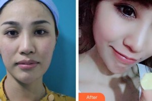 深圳愛爾眼科醫(yī)院鄭智焜整形價格表附眼部綜合案例展示