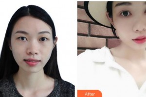 深圳?，斄猪槼毖劭漆t(yī)院施禮康整形價(jià)格表附切開雙眼皮案例展示