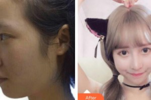 深圳愛爾眼科醫(yī)院李肖娟整形價格表附眼部綜合案例展示